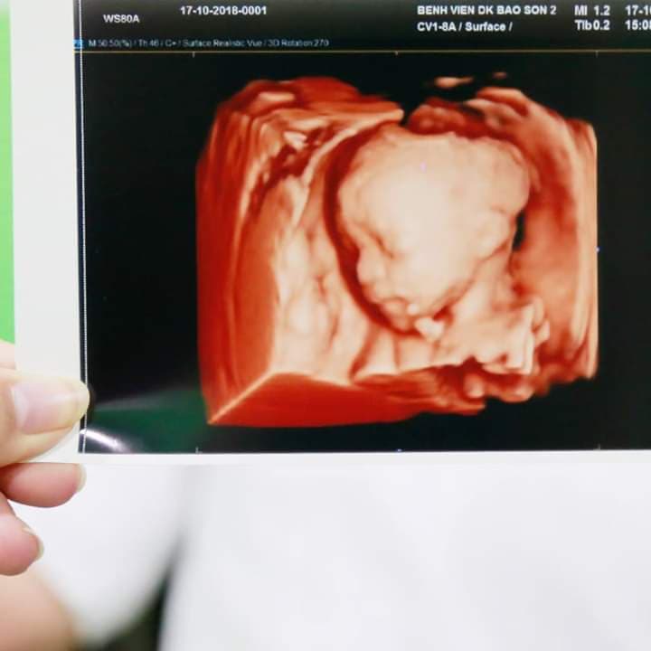 Các mốc siêu âm thai định kỳ mẹ bầu cần nhớ