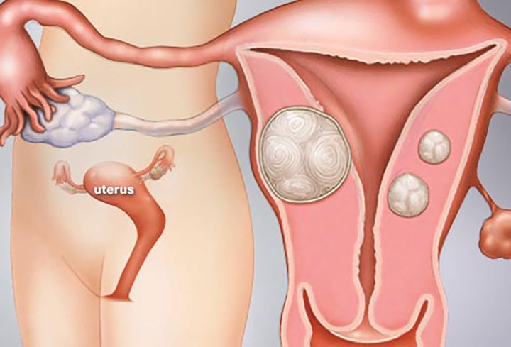 Mổ nội soi u xơ tử cung có ưu điểm gì?