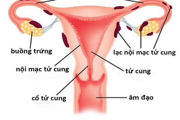Lạc nội mạc tử cung: nguyên nhân, biểu hiện và cách điều trị