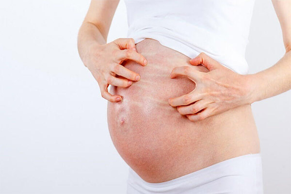 Nguyên nhân và điều trị hiện tượng nổi mề đay khi mang thai