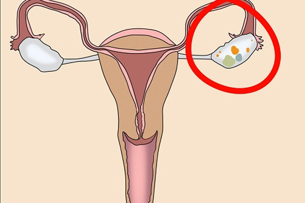 Triệu chứng, chẩn đoán và điều trị bệnh u nang buồng trứng