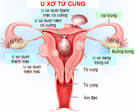 Hình minh họa các vị trí khối u xơ trong tử cung